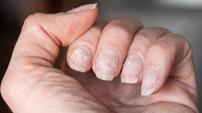 nagelreparatur-nach-dem-entfernen-von-gel-1